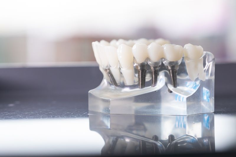 5 Things to Know About Dental Implants		